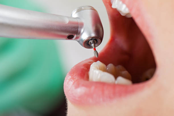 Best Chipped Tooth Repair Near Me  in Cumberland, MD